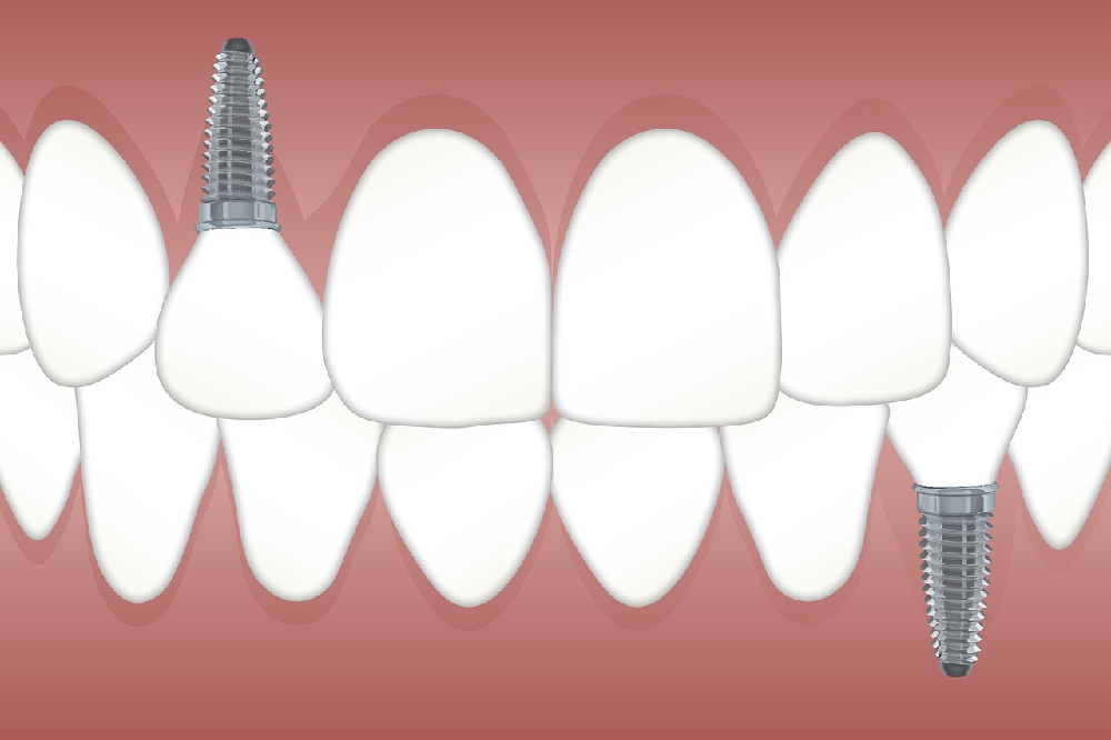 Implanty stomatologiczne, jako modny sposób na piękny uśmiech.